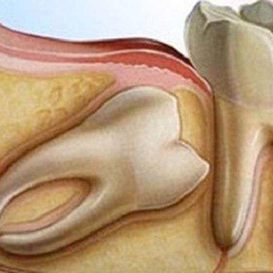 Estrazioni e cura dei denti - Centro Odontoiatrico Atena, Brindisi